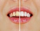 Wybielanie zębów - czy warto się zdecydować?